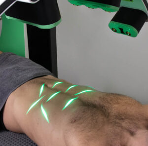 Green Laser Lipo