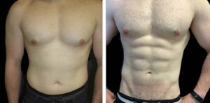 Laser and EMS Body Sculpt Before and After