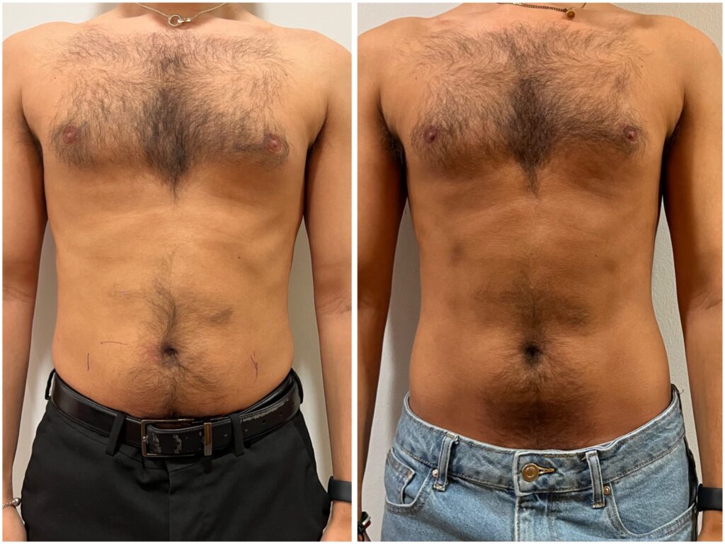 Fat Freezing Before and After
