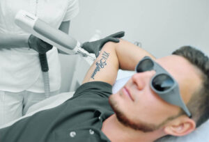 Laser Tattoo Removal