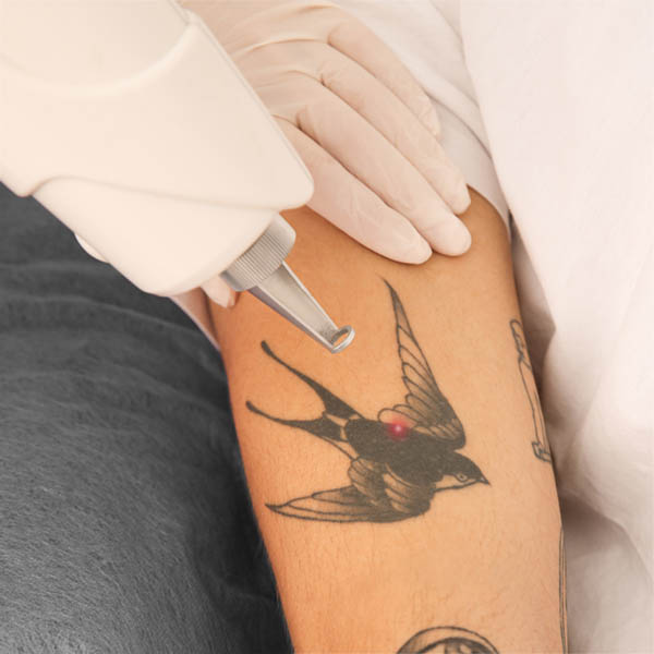 Picoway Laser Tattoo Removal
