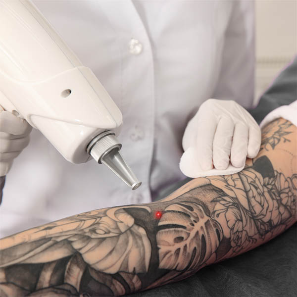 Picoway Laser Tattoo Removal