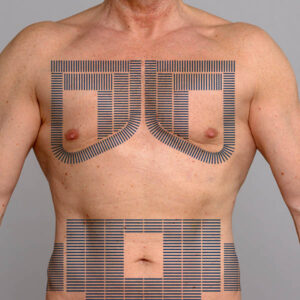 Fat Freezing - Abdomen, Flanks & Chest 