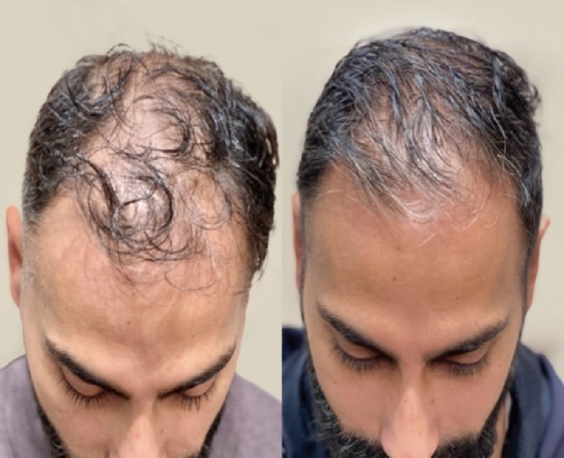 Before and After Sized for Skin Technique 37