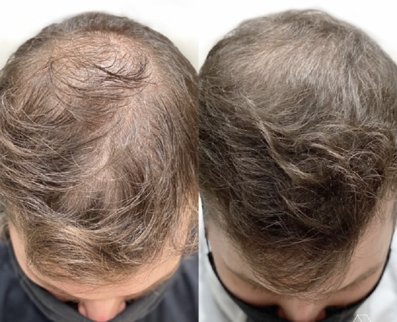 Before and After Sized for Skin Technique 46