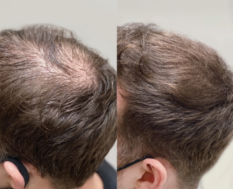 Before and After Sized for Skin Technique 47