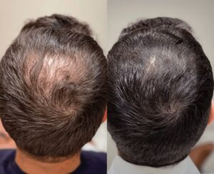 PRP Hair Restoration