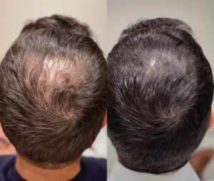 PRP Hair Restoration