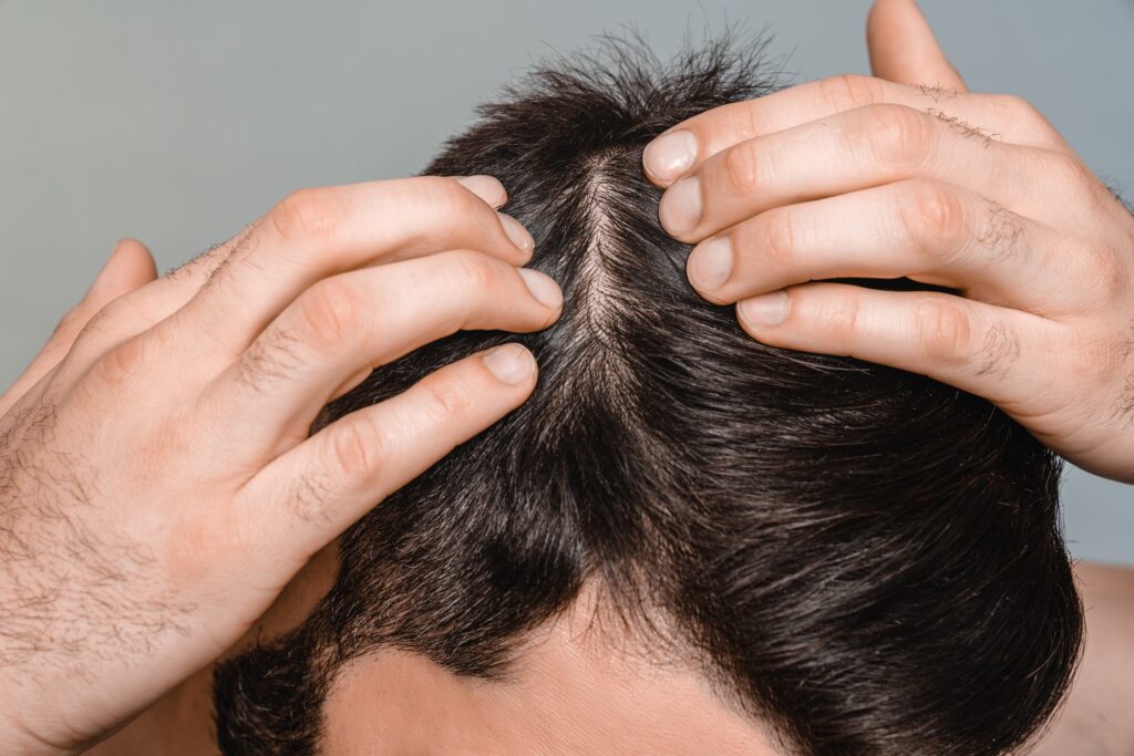 Closeup,Male,Dark,Hair.,Head,Skin,Problems,,Receding,Hairline,,Alopecia, Closeup,Male,Dark,Hair.,Head,Skin,Problems,,Receding,Hairline,,Alopecia,